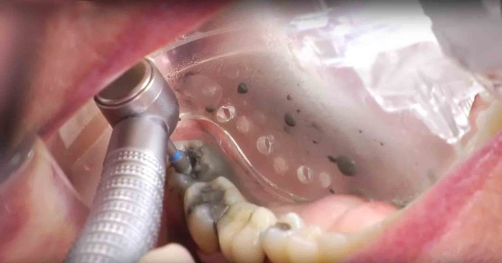 Amalgam Fillings Removal with Isolite Dental Isolation System